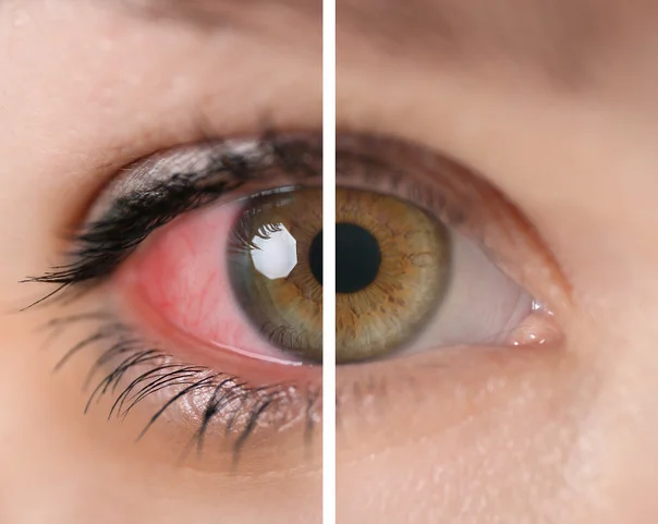 Conjunctivitis - Ophthalmic Surgeon